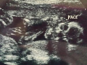Ultrasound of my first grandchild!